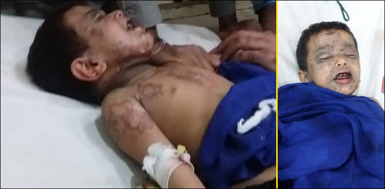 سفاک-نامعلوم-افراد-نے-5-سالہ-معصوم-بچے-پر-تیزاب-پھینک-دیا